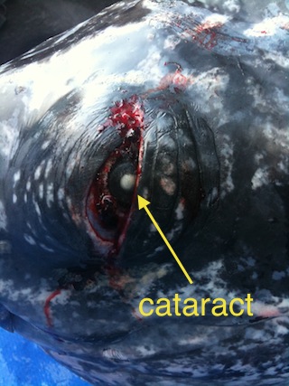 cataract